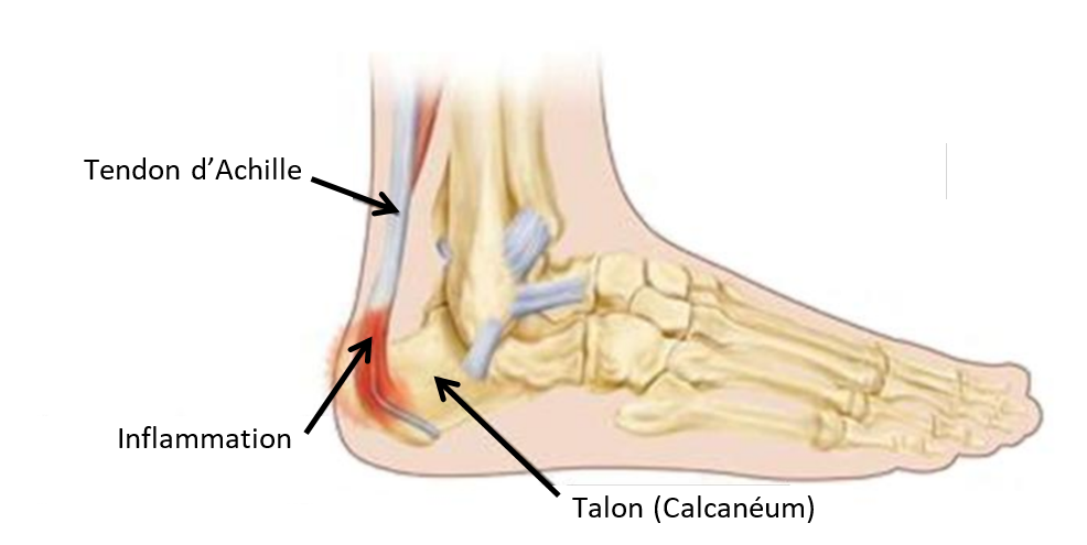maladie de sever inflammation du pied au niveau du talon