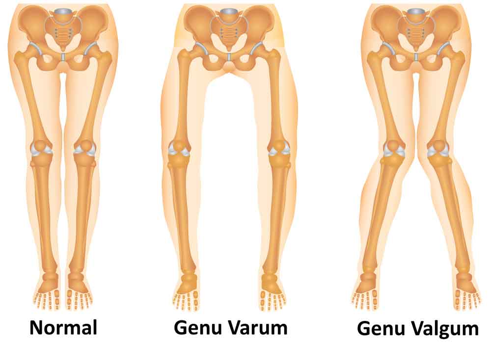 Genu Varum : Comprendre, Traiter et Prévenir cette déformation Orthopédique