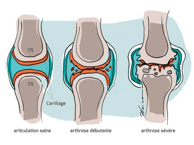 Comparaison de l’articulation normale à l'articulation arthrosique