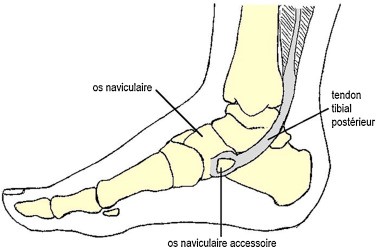 talon du pied atteint par la pathologie de Köhler-Mouchet