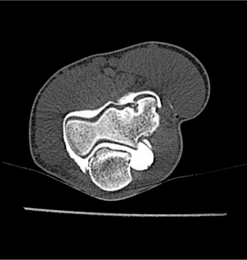 arthroscanner de la pathologie de panner