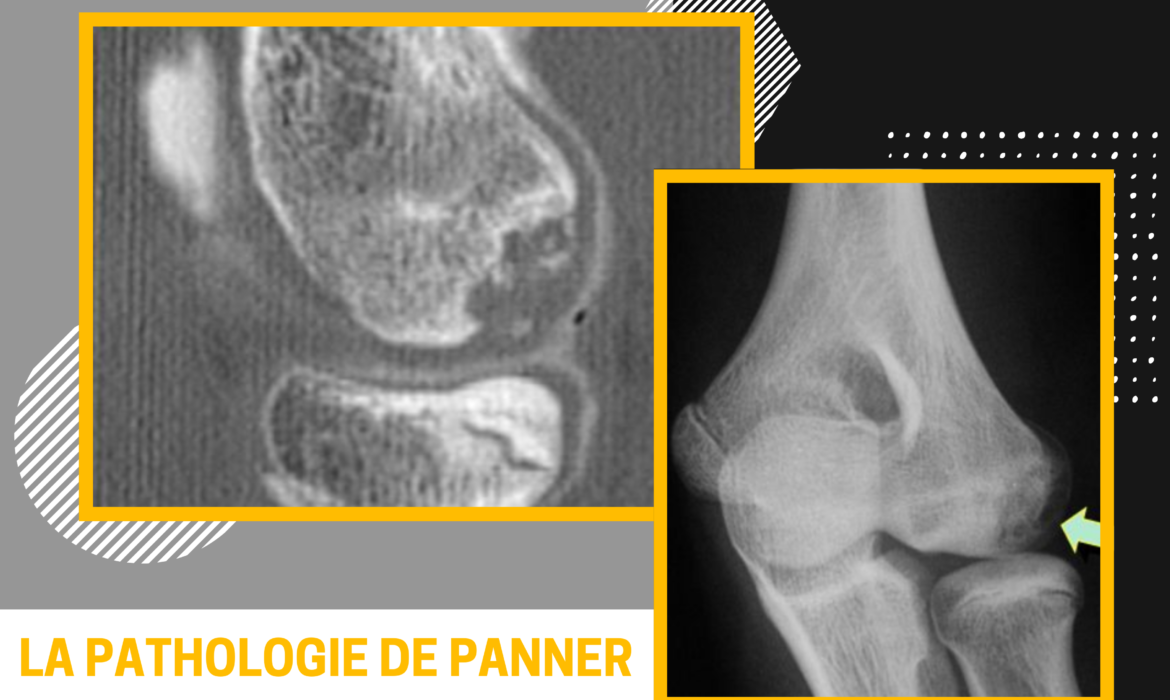 patologie de panner