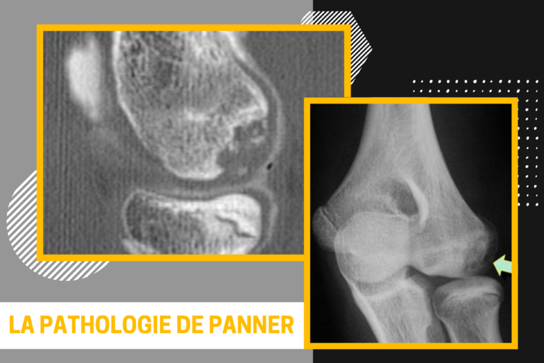 Panner : douleur au coude de l’enfant sportif