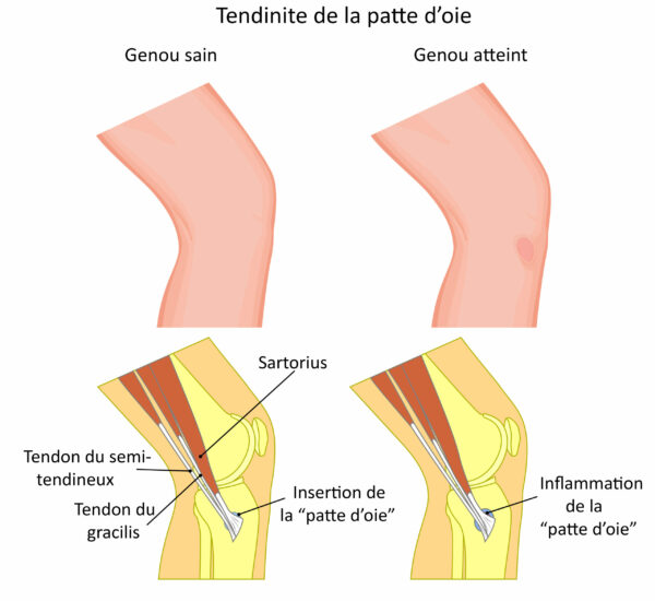 Tendinite de la Patte d'Oie