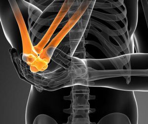 Tennis Elbow